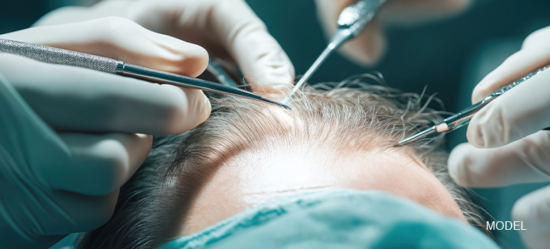 Blog 7 Fue Hair Transplant Tools