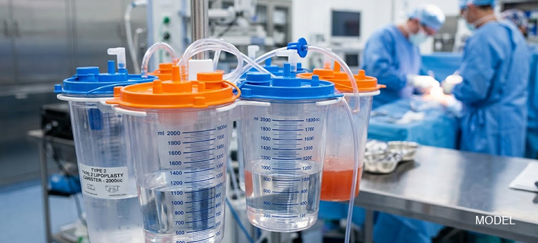 Blog 5 Reusable Lipoplasty Canisters With Overflow Filters